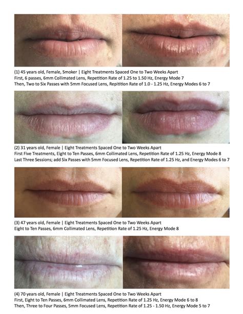 Lip laser treatment
