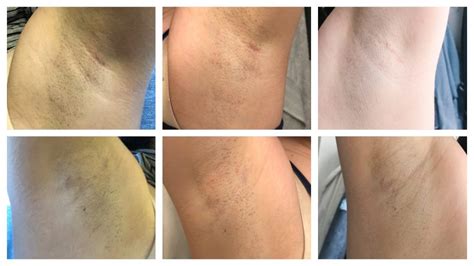 How many laser hair removal treatments are needed for underarms