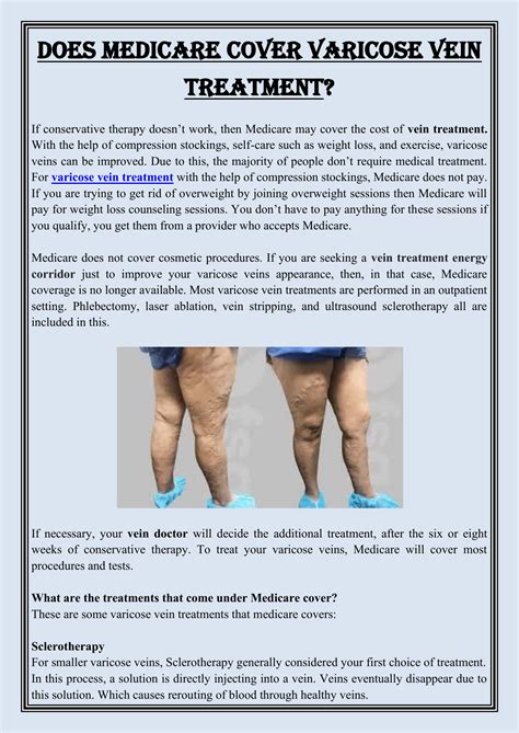Does medicare cover varicose vein treatment