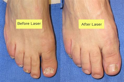 How much is laser treatment for toenail fungus