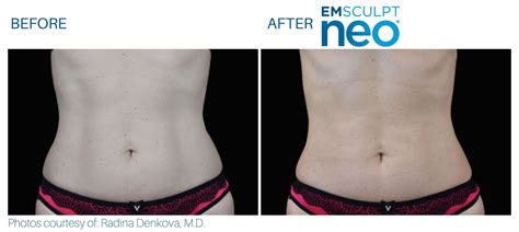 Emsculpt before and after 1 treatment