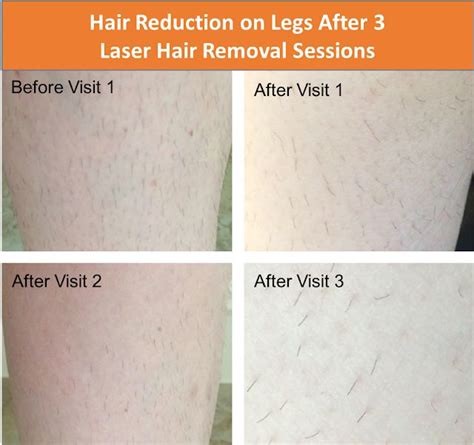 How many brazilian laser hair removal treatments