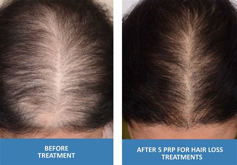 How many prp treatments are needed for hair